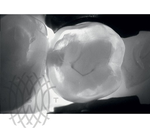 KaVo DIAGNOcam лазерная диагностика кариеса